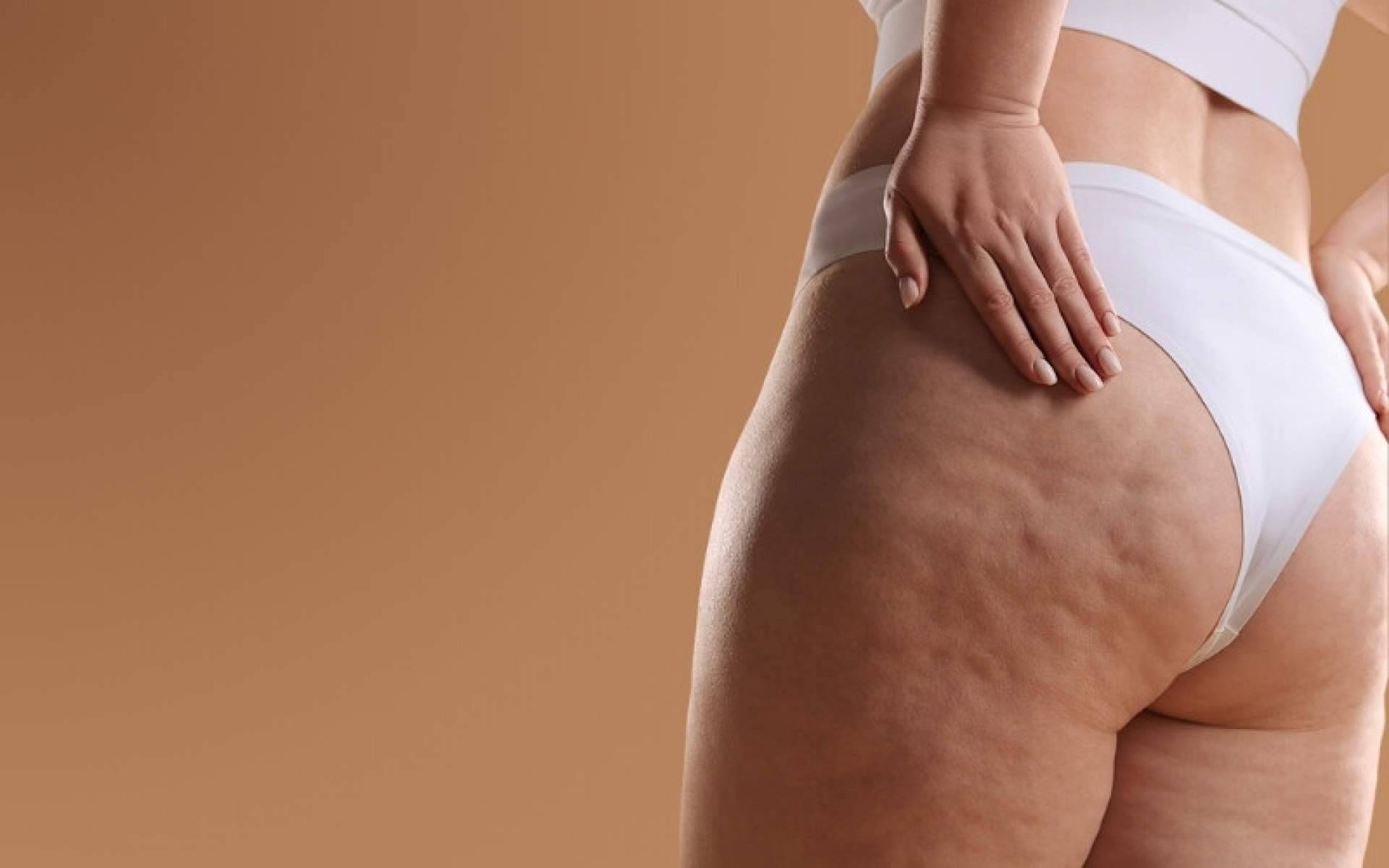 Capenergy logra 14,8 cm de reducción en celulitis en estudio clínico